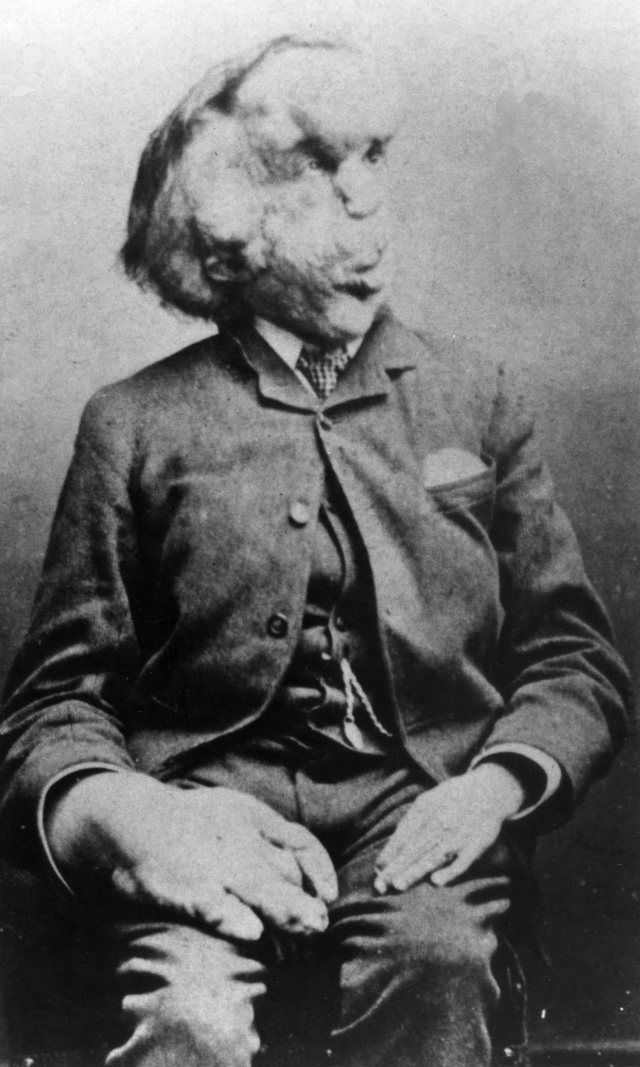 Joseph Merrick: Joseph Merrick carte de visite photo, c. 1889